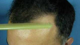 Gregs 1200 graft hair transplant result [upl. by Post]