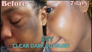 How to clear dark sunburn naturally fast [upl. by Nilrem]