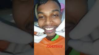 Teeth Gap Treatment in 5 Days ZirconiaCap Ulwedentist dentistnavimumbai ytshortsviral [upl. by Lennie410]