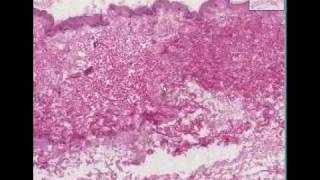 Histopathology SkinErysipelas [upl. by Delmer]