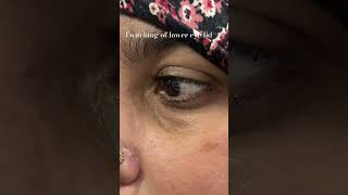 Twitching of lower eye lideyelid myokymia [upl. by Lienahs]