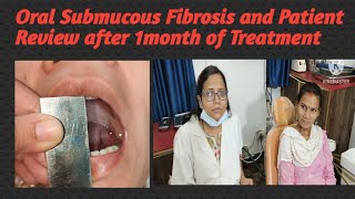 Oral Submucous Fibrosis and Patient Review after 1month of Treatment [upl. by Wayolle]