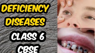 Deficiency diseases class 6 CBSE [upl. by Enelia]