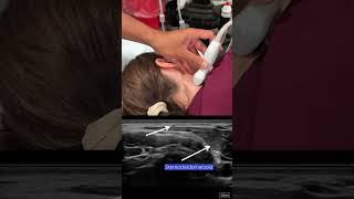 Spinal Accessory Nerve Block Scanning Technique [upl. by Fin]