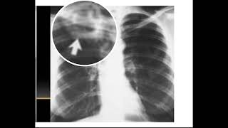 CAVERNA TUBERCULOSA EN RADIOGRAFÍA TELE DE TÓRAX [upl. by Haelahk]