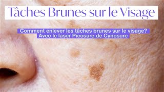 Tâches brunes sur le visage hyperpigmentation de la peau  retrait avec le laser picosure cynosure [upl. by Roque442]