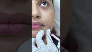 Botox Treatment  Expert Advice and Tips  Cara Clinic [upl. by Charlet566]