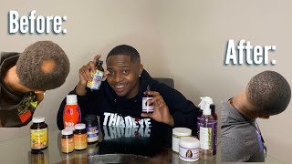 HOW I GREW MY BALD SPOT BACK FAST NATURAL HAIR GROWTH TREATMENT [upl. by Irot]