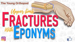 Named Fractures UPPER LIMB Fractures with EPONYMS NEET PG The Young Orthopod [upl. by Lawler]