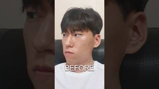 Double Jaw Surgery Transformation [upl. by Lynde]