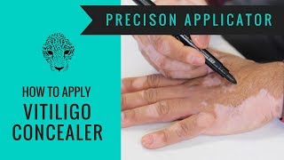 Vitiligo Makeup Tutorial  How to Cover Vitiligo  Zanderm Precision Applicator [upl. by Harwilll103]