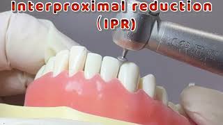 Interproximal reductionIPR、Invisalign 、orthodontic burs [upl. by Anival518]