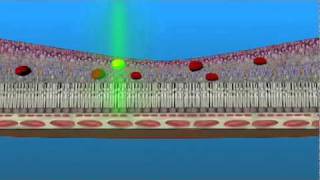 Láser Para Edema Macular [upl. by Sremmus]