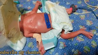 premature baby care in the nicu ward [upl. by Asenev]