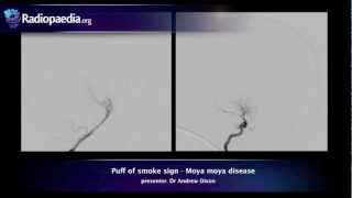 Puff of smoke sign  radiology video tutorial angiography [upl. by Drareg]