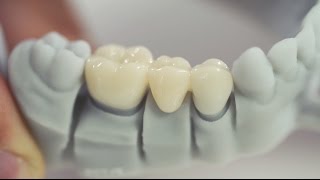 3D Printing in the Dental Laboratory fabrication of temporary crowns amp bridges with Freeprint® temp [upl. by Ellecrag]