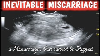 Inevitable Miscarriage  Early Pregnancy Missed Abortion [upl. by Marinna]