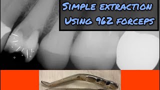 Simple Premolar Extraction with My 962 Forceps [upl. by Enar]