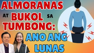 Almoranas at Bukol sa Tumbong Ano ang Lunas  By Doc Willie Ong [upl. by Oznecniv]