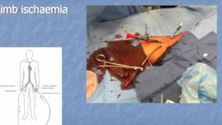 ICN ECMO Part 2 [upl. by Nnasor]