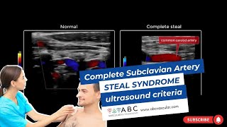 Complete Subclavian Artery Steal Syndrome ultrasound criteria [upl. by Sivrup]