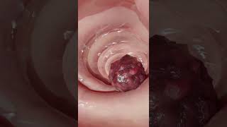 Doctor Finds Huge Blood Clot Inside Patient Must See Surgery Footage [upl. by Crain]