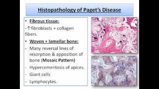 Bone DiseasesFibroosseous amp Developmental lesionsOral Pathologywmv [upl. by Ecart]