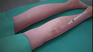 Sclerotherapy Procedure [upl. by Aylad897]