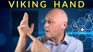 Dupuytren’s Contracture  All about the ‘Viking Hand’ [upl. by Nywde12]