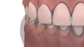 Gingivoplastie et gingivectomie  Centres dentaires Lapointe [upl. by Ecinhoj]