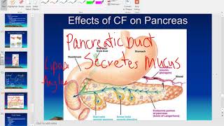 Pathophysiology of Cystic Fibrosis [upl. by Amihsat]