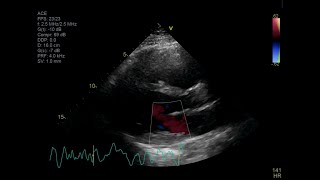 Fatal Giant Cell Myocarditis [upl. by Warder62]