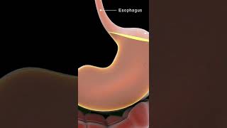 Understanding Achalasia Cardia  Causes amp Solutions [upl. by Patterson]