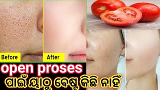 oilskin ପାଇଁacenipimpils open proses ପାଇଁ ୟାଠୁ ବେଷ୍ଟ କିଛି ନାହିଁସବୁଠୁ ବେଷ୍ଟ 🥰 home remidy ranjita [upl. by Hammock]