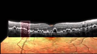 SPECTRALIS  Simultaneous Imaging [upl. by Daniela476]