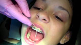 How to floss with braces by Orthodontist in Rogers AR [upl. by Ashly132]