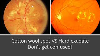 Classification of Diabetic Retinopathy [upl. by Season]