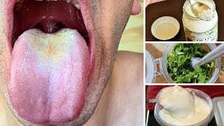 10 Remedios Caseros Para Tratar La Candidiasis Oral [upl. by Banerjee935]