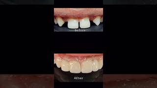 Congenitally missing maxillary lateral incisors rehabilitated using Emax crown cosmeticdentistry [upl. by Karry289]