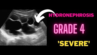 Hydronephrosis Grade 4 Severe  Ultrasound Case [upl. by Dee Dee321]