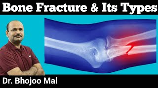 Bone Fracture and Its Types  Class 12 Biology  by Dr Bhojoo Mal [upl. by Ennaihs]