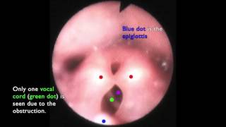 Laryngomalacia  The Floppy Airway [upl. by Hernando209]