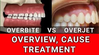 Overbite VS Overjet  Condition Overview Cause and Treatment [upl. by Dorcas285]