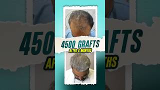 4500 Grafts Hair Transplant  6 Months Result hairtransplant hairtutorial hair shorts [upl. by Gnal]