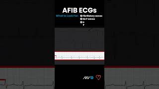 What to Look for in an AFib ECG [upl. by Leighland705]