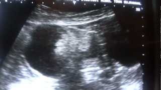 DERMOID CYST ultrasound [upl. by Siraval281]