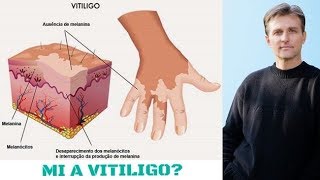 Dr Berg Mi a vitiligo [upl. by Uba]