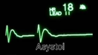 ASYSTOLE AND SVT ON ECG CLIP [upl. by Meela]