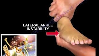 Chronic Lateral Ankle Instability  Everything You Need To Know  Dr Nabil Ebraheim [upl. by Oilime]