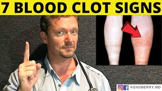 7 Warning Signs of a BLOOD CLOT Symptoms 2024 [upl. by Suiravad]